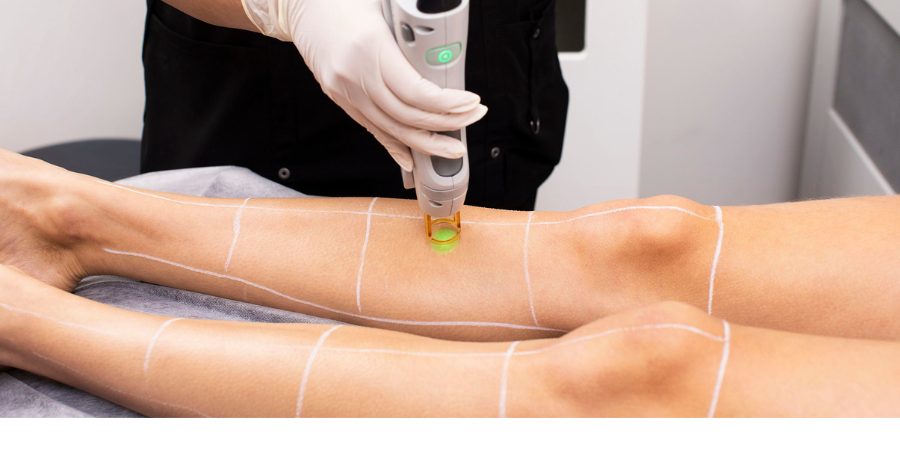 Quanta System laser hair removal